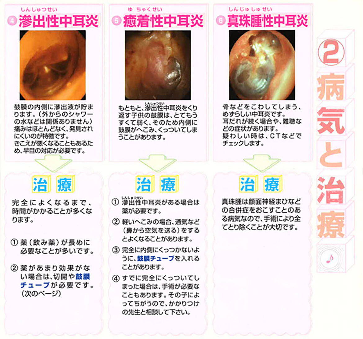 病気と治療　中耳炎